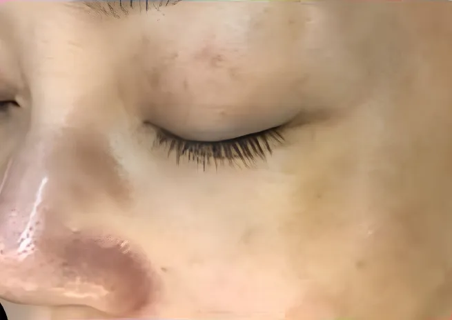 Skóra po zabiegu — Melasma policzka · 4 sesje