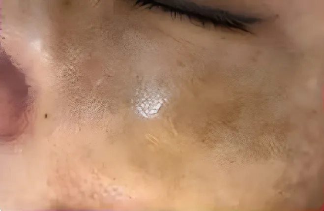 Skóra przed zabiegiem — Melasma policzka · 4 sesje